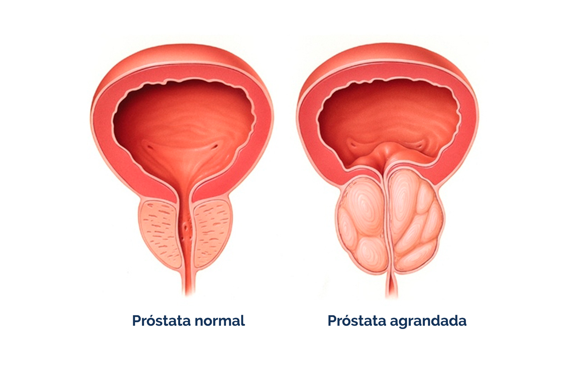 hiperplasia prostática benigna